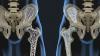 Kalsiyum osteoporoz alınmamalıdır Neden? Kalsiyum Hakkında gerçeği ve nasıl iyi durumda kemik dokusu korumak için
