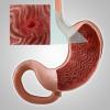 Gastrit veya midenin erozyonu: Başlıca belirtileri, tedavisi, diyet