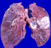 Akciğer kanseri: değil nasıl hastalığın başlangıcını kaçırmak?