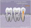 Lumident'te diş kanalları nasıl bulunur ve tedavi edilir