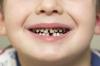 Süt dişlerindeki çürük nasıl durdurulur - diş tavsiyesi