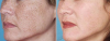 Yüz, boyun ve dekolte üzerine pigmentasyon için en iyi çare. etkisi hemen 1 kullanımdan sonra fark edilebilir
