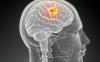 Yeni başlayan beyin tümörü belirtileri