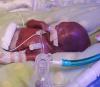 Dünyanın en prematüre bebeği