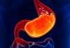 Sen gastritis: 6 olmayan belirgin işaretler