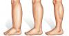 Bacaklarda şişme ve ağrı kurtulmak almak için 5 etkili ipuçları