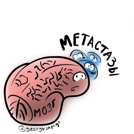 Beyin metastazları